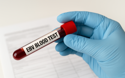 How an EBV Blood Test Helps Diagnose Epstein-Barr Virus